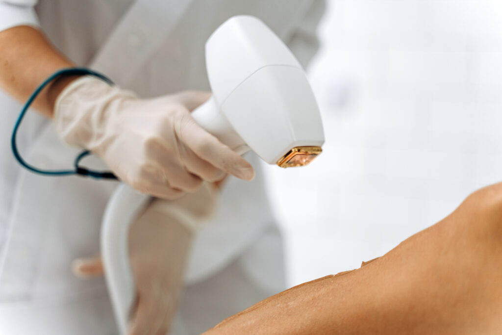 épilation au laser